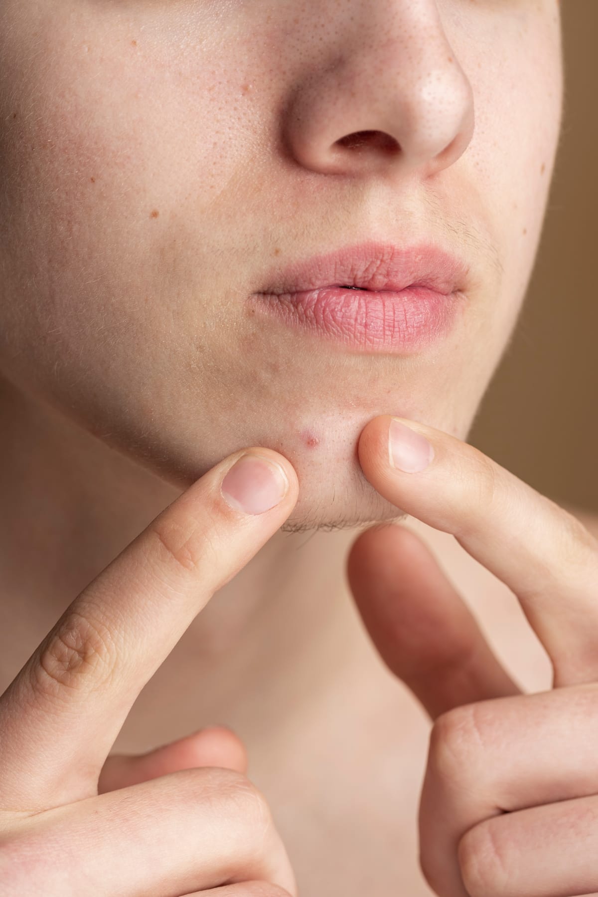 Do Pimple Patches Work on Unpopped Pimples?