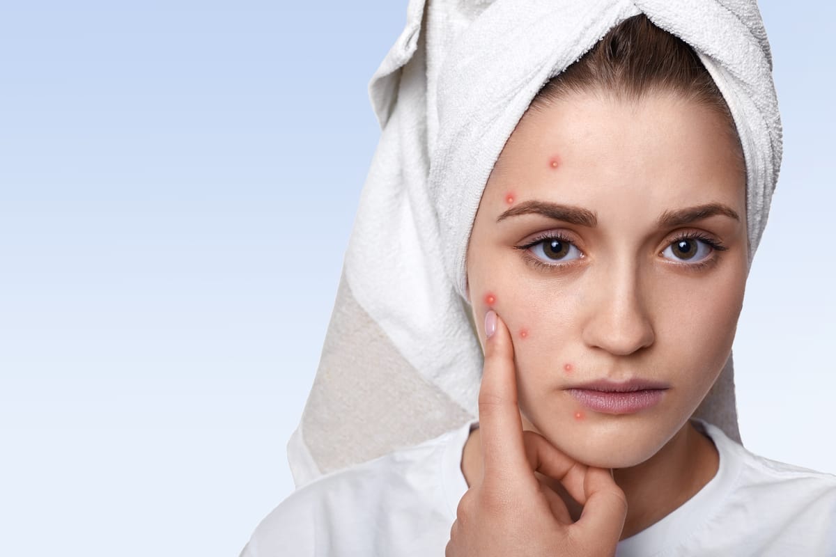 Do Pimple Patches Actually Work?